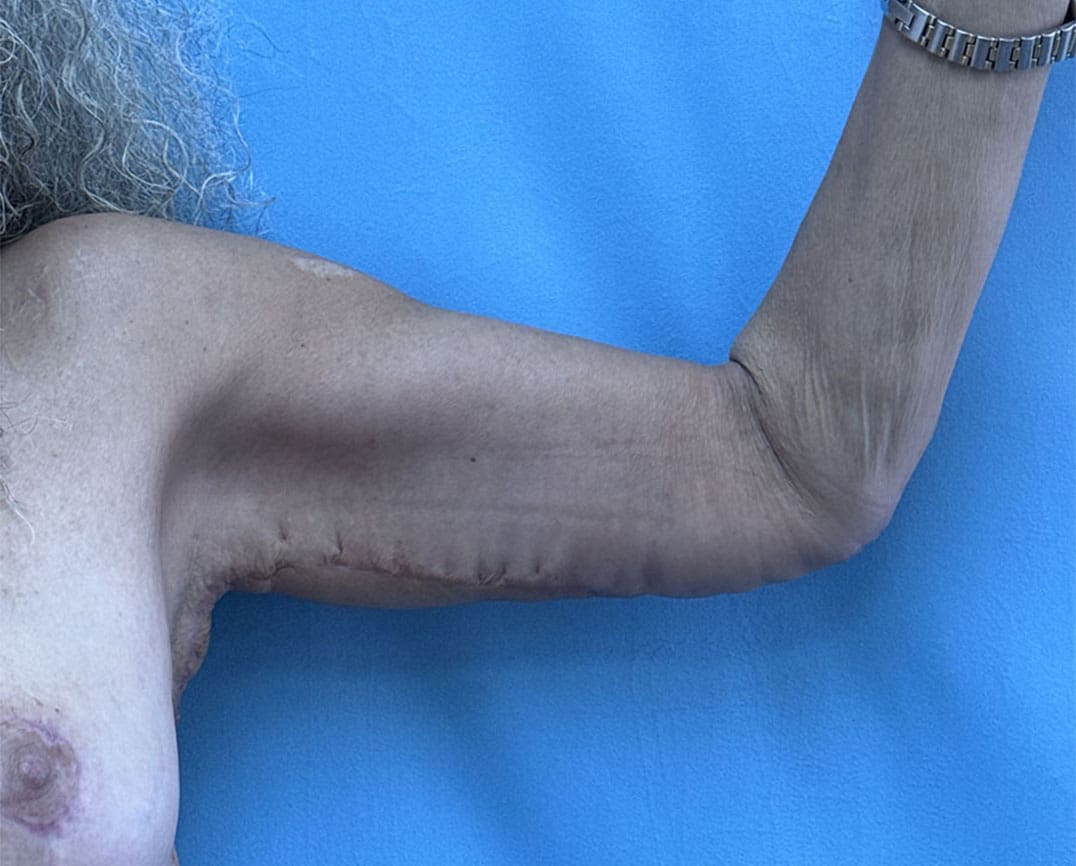 Arm Lift Before & After Pictures near Fort Lauderdale, FL