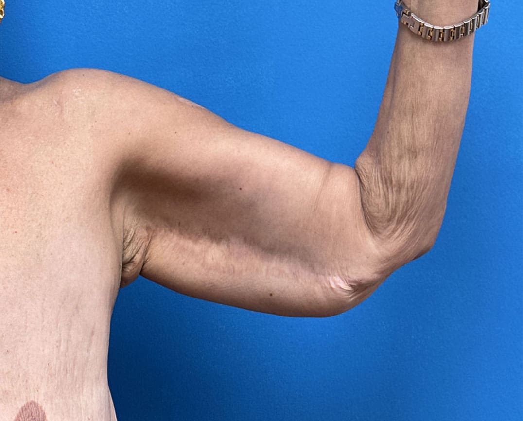 Arm Lift Before & After Pictures near Fort Lauderdale, FL