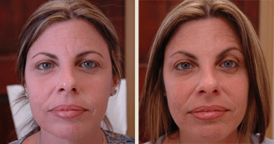 Botox/Dysport Before and After Pictures Fort Lauderdale, FL