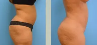 Liposuction Before and After Pictures Fort Lauderdale, FL
