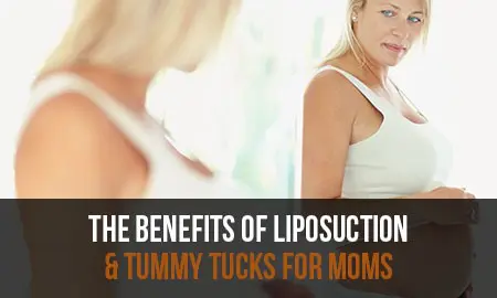 Liposuction near Fort Lauderdale, FL