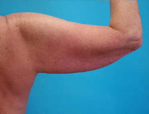 Arm-Lift-09 Brachioplasty Before and After Pictures Fort Lauderdale, FL