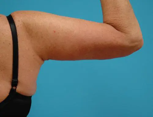 Arm-Lift-10 Brachioplasty Before and After Pictures Fort Lauderdale, FL