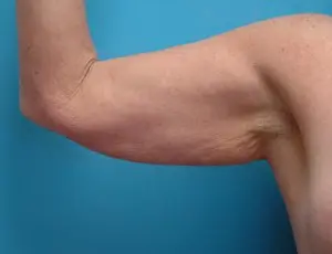 Brachioplasty Before and After Pictures Fort Lauderdale, FL