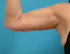 Brachioplasty Before and After Pictures Fort Lauderdale, FL