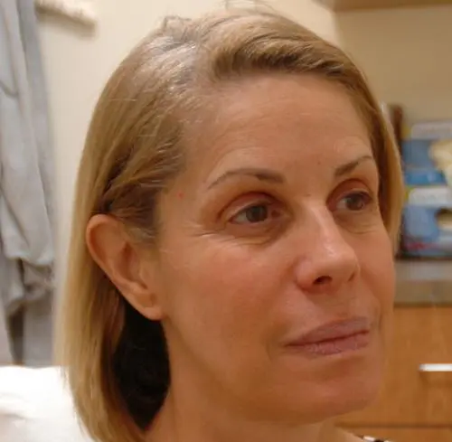 Botox-Dysport01 Botox/Dysport Before and After Pictures Fort Lauderdale, FL