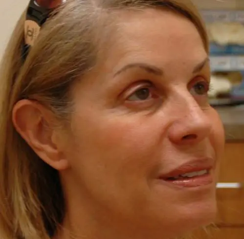 Botox-Dysport02 Botox/Dysport Before and After Pictures Fort Lauderdale, FL