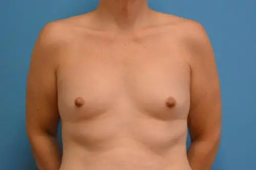 Breast Augmentation Before and After Pictures Fort Lauderdale, FL