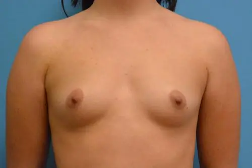 Breast Augmentation Before and After Pictures Fort Lauderdale, FL