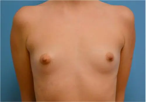 Breast Augmentation Before and After Pictures Fort Lauderdale, FL