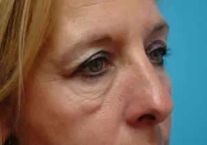 Brow Lift Before and After Pictures Fort Lauderdale, FL