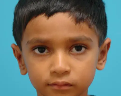 Ear-Surgery-02 Otoplasty Before and After Pictures Fort Lauderdale, FL