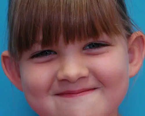 Ear-Surgery-05 Otoplasty Before and After Pictures Fort Lauderdale, FL