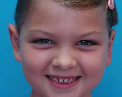 Ear-Surgery-06 Otoplasty Before and After Pictures Fort Lauderdale, FL