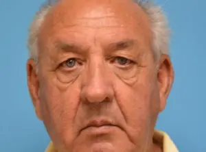 Blepharoplasty Before and After Pictures Fort Lauderdale, FL