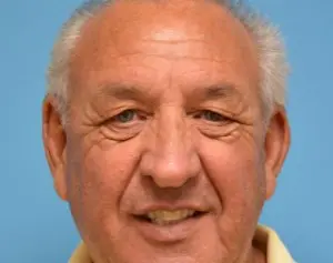 Blepharoplasty Before and After Pictures Fort Lauderdale, FL