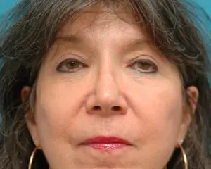 Blepharoplasty Before and After Pictures Fort Lauderdale, FL