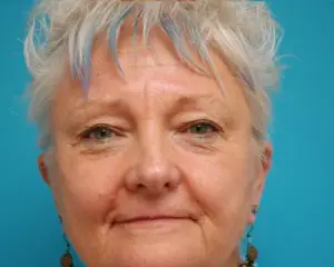 Blepharoplasty Before and After Pictures Fort Lauderdale, FL