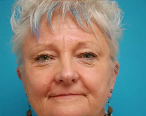 Eyelid-Surgery-25 Blepharoplasty Before and After Pictures Fort Lauderdale, FL