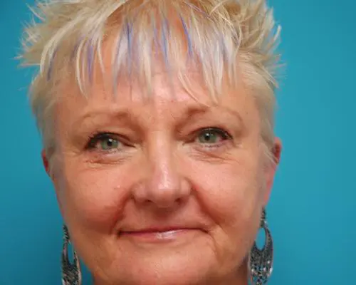 Eyelid-Surgery-26 Blepharoplasty Before and After Pictures Fort Lauderdale, FL