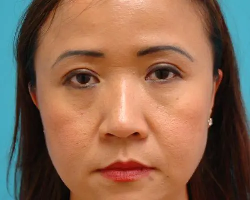 Eyelid-Surgery-30 Blepharoplasty Before and After Pictures Fort Lauderdale, FL