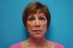 Facelift Before and After Pictures Fort Lauderdale, FL