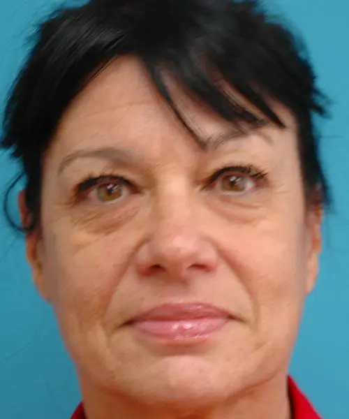 Face-Lift-33 Facelift Before and After Pictures Fort Lauderdale, FL