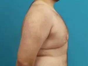 Gynecomastia Before and After Pictures Fort Lauderdale, FL