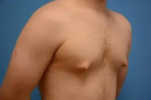 Gynecomastia Before and After Pictures Fort Lauderdale, FL