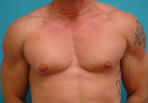 Gynecomastia Before and After Pictures Fort Lauderdale, FL