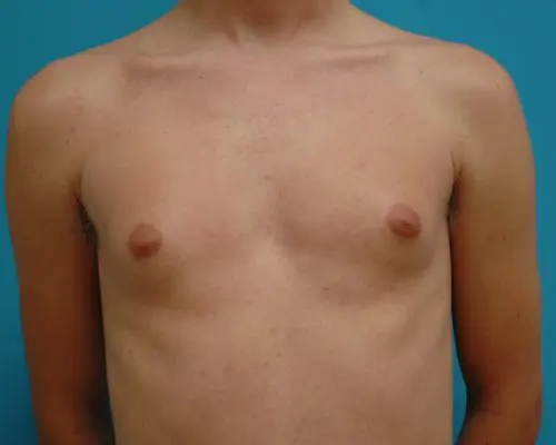 Male Breast Reduction 25 Gynecomastia Before and After Pictures Fort Lauderdale, FL
