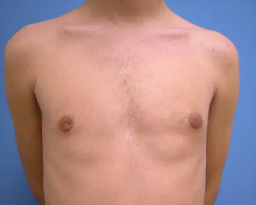 Male Breast Reduction 26 Gynecomastia Before and After Pictures Fort Lauderdale, FL