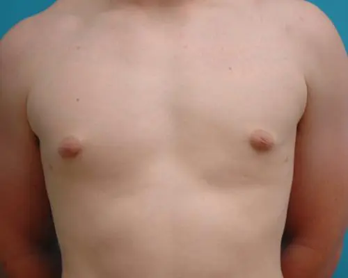 Male Breast Reduction 30 Gynecomastia Before and After Pictures Fort Lauderdale, FL