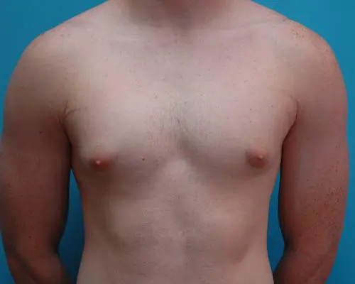 Male Breast Reduction 33 Gynecomastia Before and After Pictures Fort Lauderdale, FL