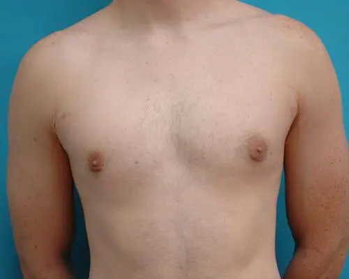 Male Breast Reduction 34 Gynecomastia Before and After Pictures Fort Lauderdale, FL
