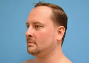 Male Liposuction Before and After Pictures Fort Lauderdale, FL