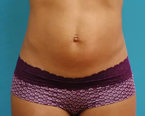 MiniTummyTuck-21 Mini Tummy Tuck Before and After Pictures Fort Lauderdale, FL