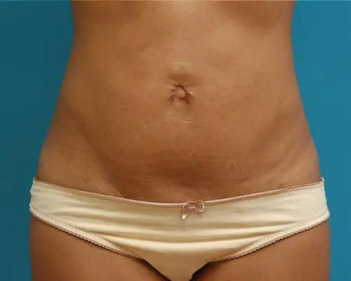 MiniTummyTuck-22 Mini Tummy Tuck Before and After Pictures Fort Lauderdale, FL