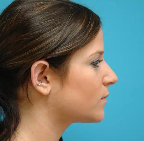 Neck-Liposuction-06 Neck Liposuction Before and After Pictures Fort Lauderdale, FL