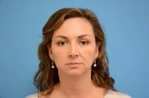 Rhinoplasty Before and After Pictures Fort Lauderdale, FL