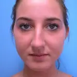 Rhinoplasty Before and After Pictures Fort Lauderdale, FL