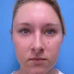 Rhinoplasty Before and After Pictures Fort Lauderdale, FL