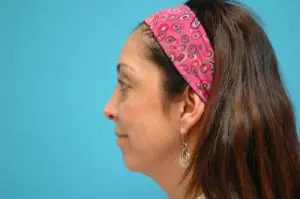 Sculptra Before and After Pictures Fort Lauderdale, FL