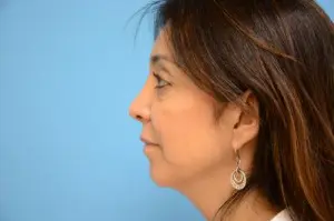 Sculptra Before and After Pictures Fort Lauderdale, FL