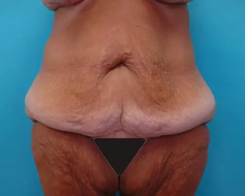 body-lift-05 Lower Body Lift Before and After Pictures Fort Lauderdale, FL