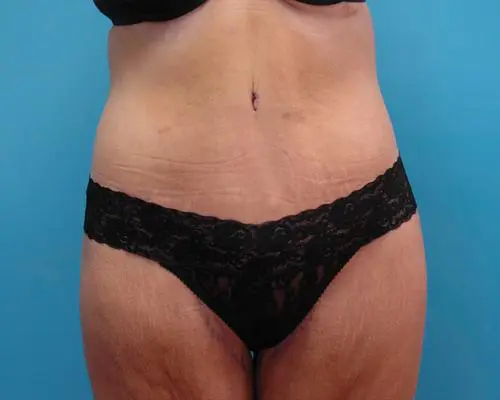 body-lift-06 Lower Body Lift Before and After Pictures Fort Lauderdale, FL