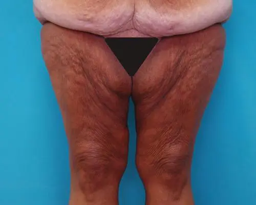 body-lift-07 After Massive Weight Loss Before and After Pictures Fort Lauderdale, FL