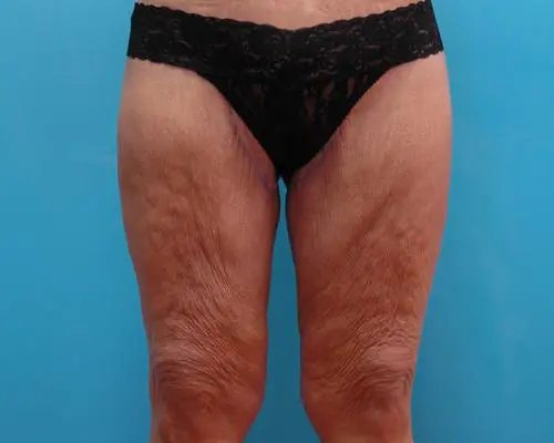 body-lift-08 After Massive Weight Loss Before and After Pictures Fort Lauderdale, FL