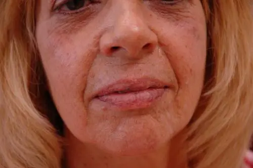 lip-augmentation-01 Lip Augmentation Before and After Pictures Fort Lauderdale, FL