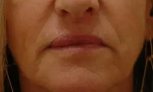 Lip Augmentation Before and After Pictures Fort Lauderdale, FL